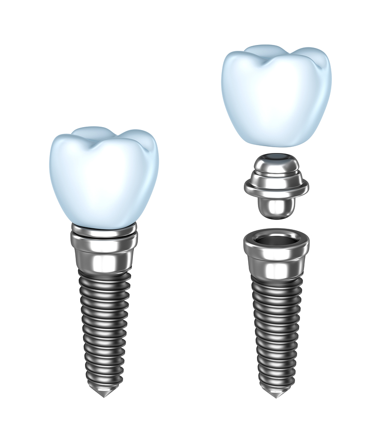 Tustin Dental Implant Diagram