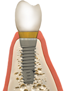 Tustin bone grafting with dental implant